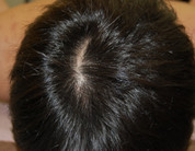 円形脱毛症の治療｜円形脱毛症の治療結果